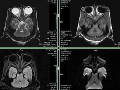 Modèl Maladi Parkinson la
